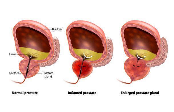 Ang prostatitis ay isang pamamaga ng prosteyt glandula