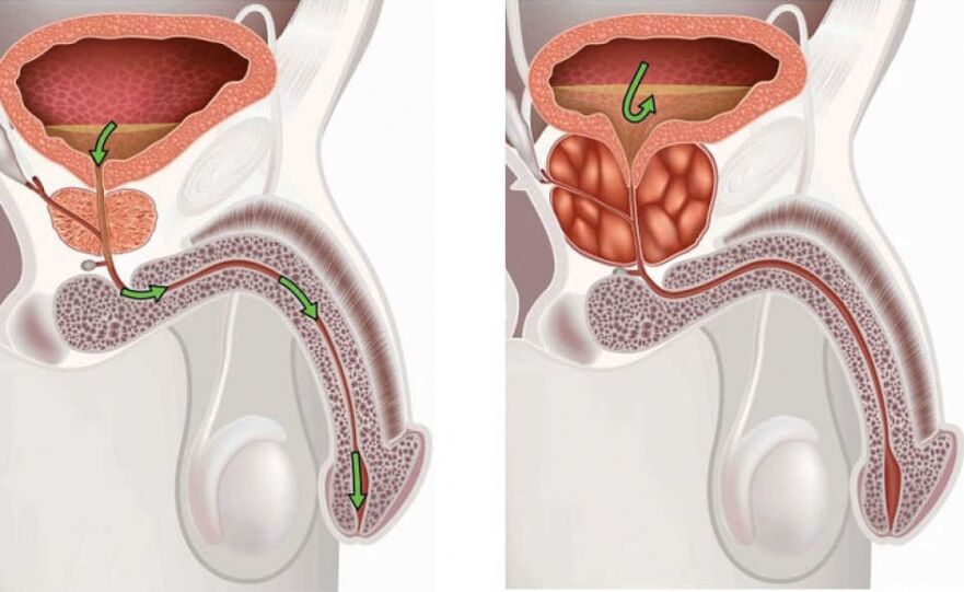 mint az urethritis különbözik a prosztatitistól benigne prostatahyperplasie bph symptome