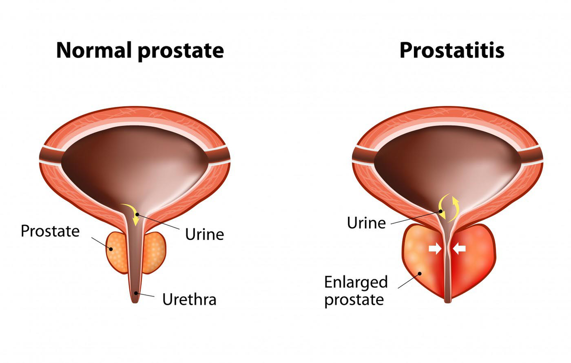 Normal na prostate ng isang malusog na lalaki at pamamaga ng prostate gland na may prostatitis